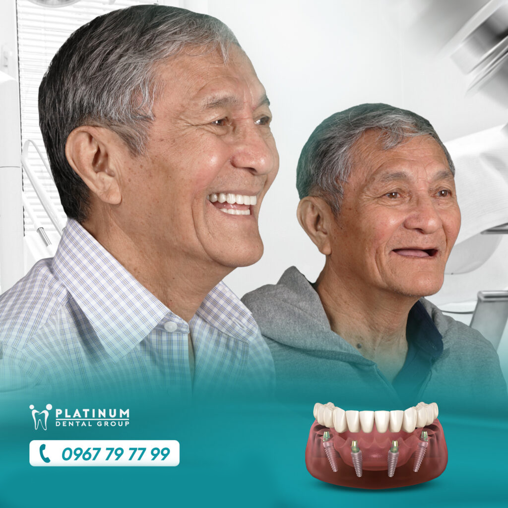 Dịch vụ 7 trong rang implant toan ham