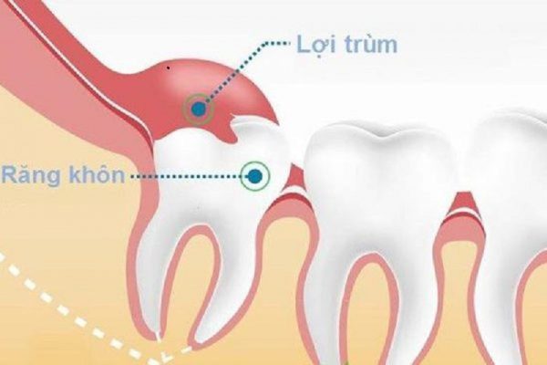 Viêm Lợi Trùm Răng Khôn: Nguyên Nhân, Triệu Chứng Và Giải Pháp Chữa Trị 23 Lợi trùm răng khôn là gì?