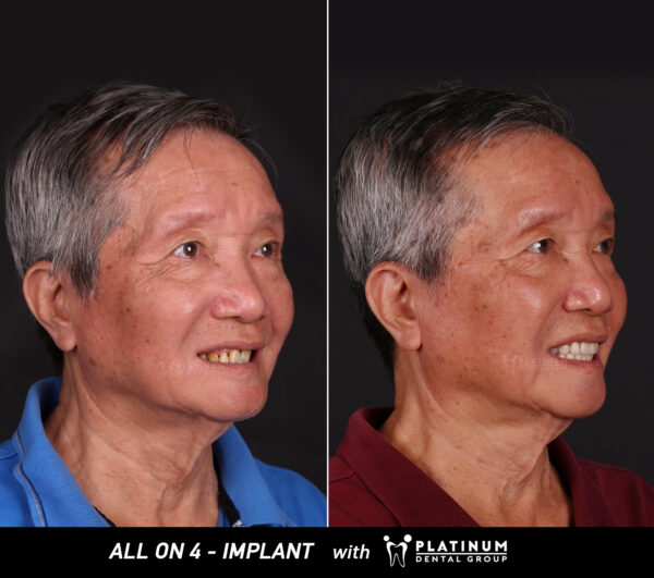 11 allon4 1 thắng 2