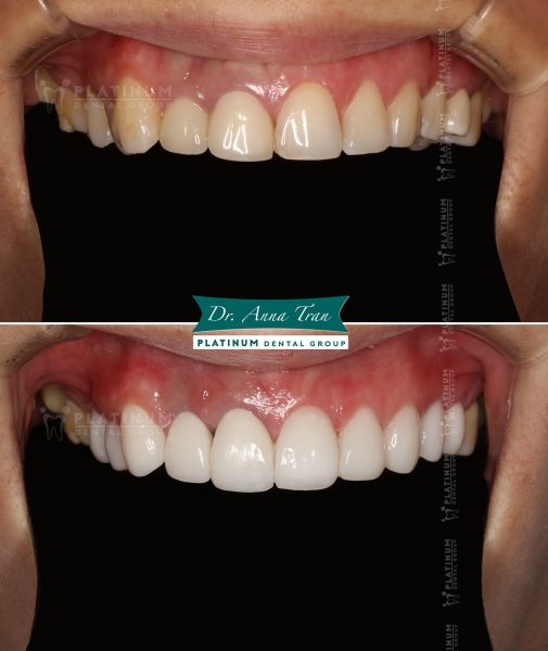 Tân trang lại những khuyết điểm trên răng 8 333043926 536407788479131 1421386694065919663 n