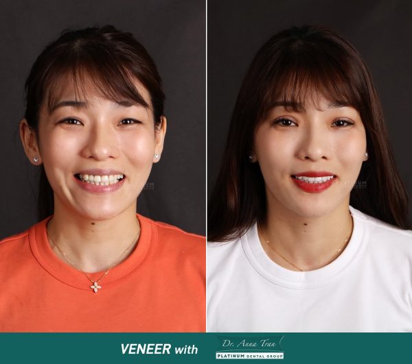 Tân trang lại những khuyết điểm trên răng 6 333086956 214028114510321 1937236346014695372 n