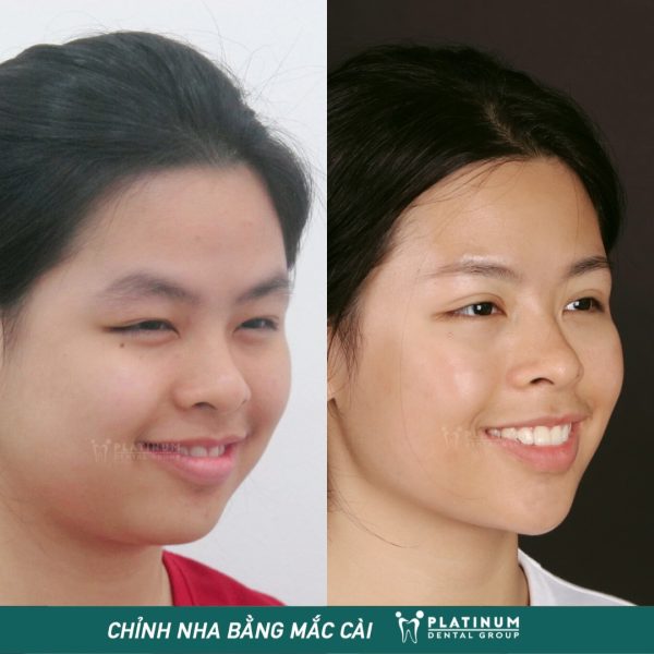 Anh Thư đã hoàn thiện nét đẹp nụ cười cho gương mặt thanh tú 4 336893623 167069355799994 7157699826739794177 n