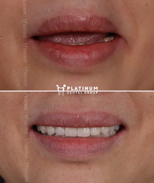 Allon6 3 Lệ DUng 3