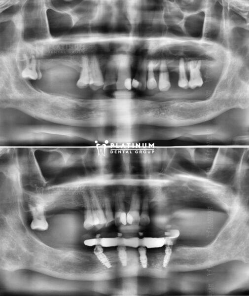 X Nguyễn Cao Thắng
