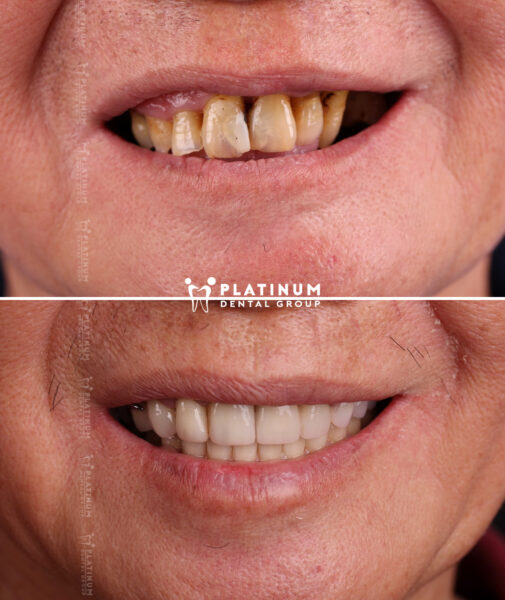 allon4 1 thắng 3