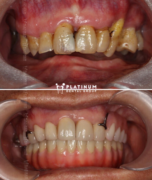 allon4 1 thắng 4