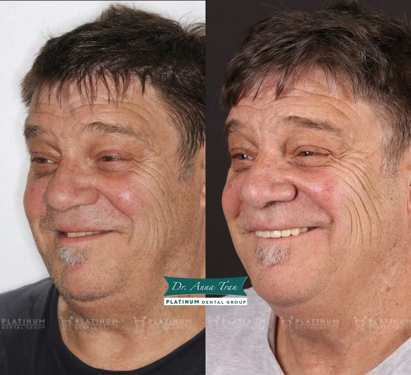 Mr Andrew "Lẽ ra tôi nên đến Platinum sớm hơn" 8 allon4 6 MrAndew 3