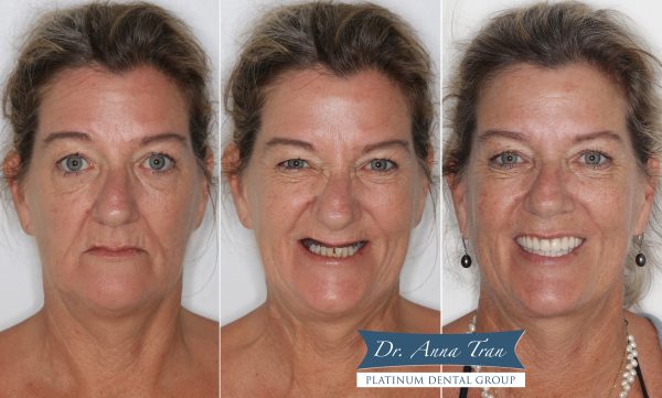 Nụ cười tươi tràn đầy tự tin của cô Annett đến từ Úc 6 allon4 7 Annett 3h