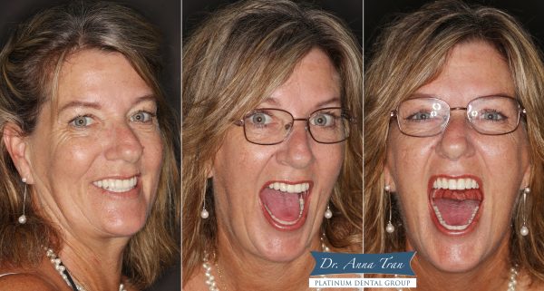 Nụ cười tươi tràn đầy tự tin của cô Annett đến từ Úc 10 allon4 7 Annett 3h cuoi