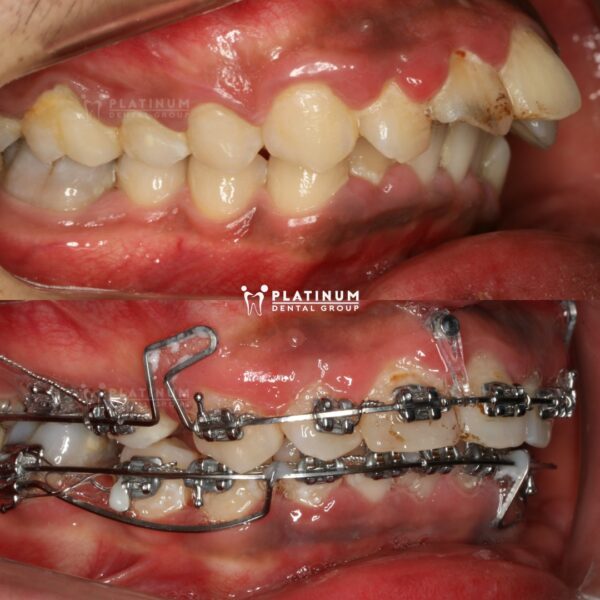 Cải thiện nụ cười sau khoảng 1 năm chỉnh nha 6 caithiennucuoi2