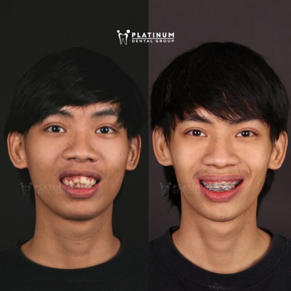 Cải thiện nụ cười sau khoảng 1 năm chỉnh nha 7 caithiennucuoi3