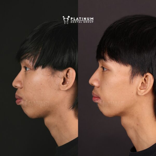 Cải thiện nụ cười sau khoảng 1 năm chỉnh nha 8 caithiennucuoi4