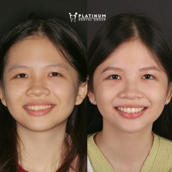 Kết thúc điều trị xô lệch với chỉnh nha 8 chinhnhatre4