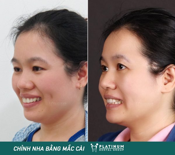 Kết thúc một case niềng răng mắc cài 8 maccai4