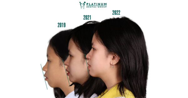 Cân đối tỉ lệ vàng khuôn mặt nhờ chỉnh nha 3 tilevang1