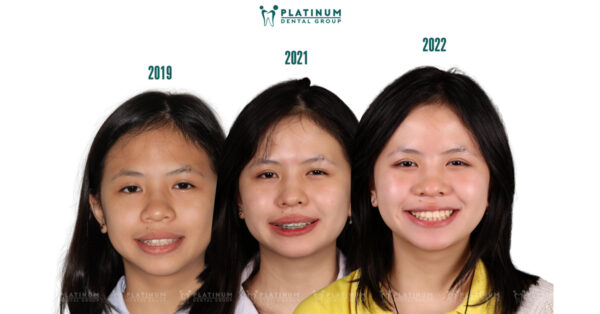 Cân đối tỉ lệ vàng khuôn mặt nhờ chỉnh nha 4 tilevang2