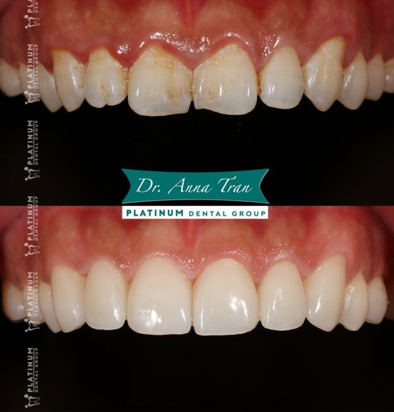 Không ai phát hiện ra là mình đã đi làm răng 5 xuantrung2