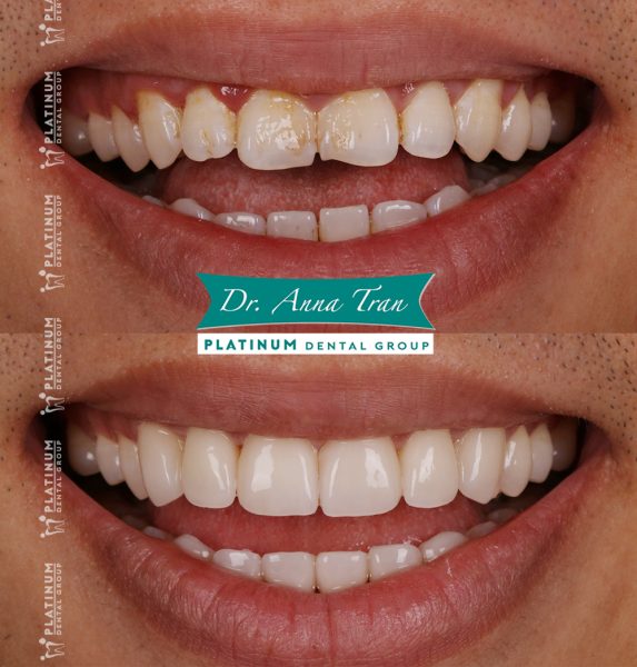 Không ai phát hiện ra là mình đã đi làm răng 6 xuantrung3