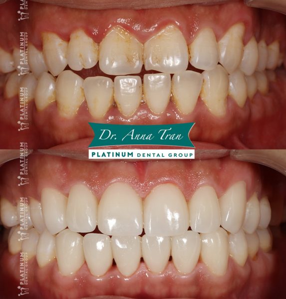 Không ai phát hiện ra là mình đã đi làm răng 7 xuantrung4