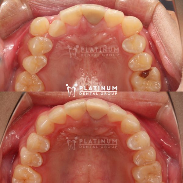 Chỉnh nha giúp hàm răng thẳng đều khoẻ mạnh 6 z4187083083910 ef0bb378b4a441b27d937e64de2e14f6