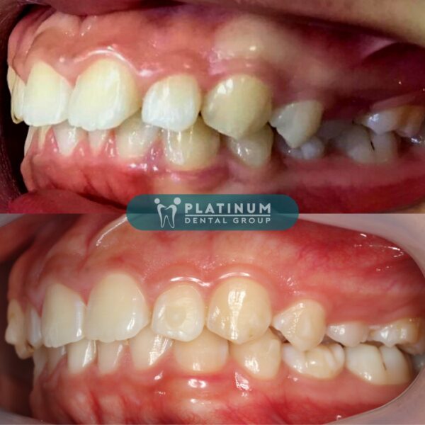 INVISALIGN - HOÀN THIỆN NỤ CƯỜI 8 288841352 3208205599420146 1681433641953350529 n