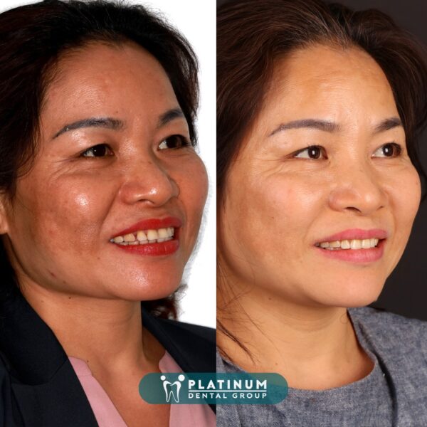 CÂU CHUYỆN ĐẦU TƯ NIỀNG RĂNG Ở TUỔI U40 TRỞ LÊN 8 289836639 3212844412289598 306789757567612205 n