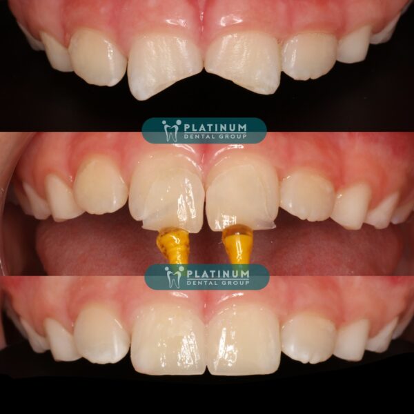 VENEER KHÔNG MÀI - KHÔNG Ê - KHÔNG ĐAU 4 293990528 3230049090569130 2795980196691751070 n