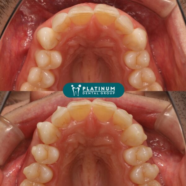 INVISALIGN - Tiến trình hoàn thiện nụ cười 6 296645478 3241269749447064 9123742376690544940 n