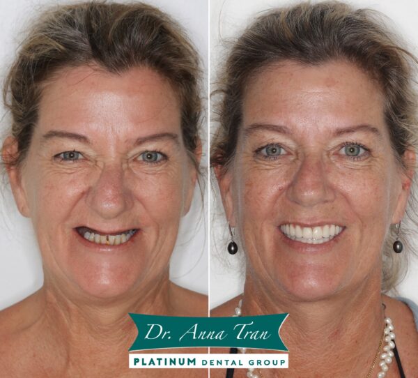 IMPLANT - Từ nụ cười không hoàn hảo đến nụ cười đầy đủ chức năng 8 341570029 204466008998647 7445694531958333871 n