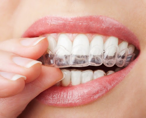 Cách làm trắng răng bằng vỏ chuối – Hiệu quả trắng sáng bất ngờ 4 Tẩy trắng tại nhà