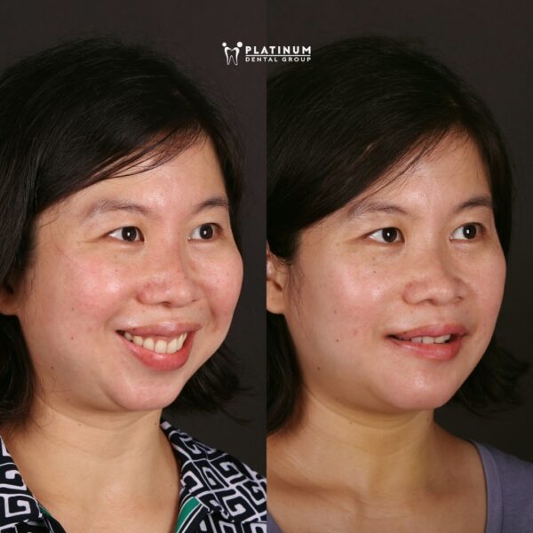 Ca điều trị đặc biệt "Hội chứng ngưng thở khi ngủ" & cải thiện thẩm mỹ 8 rina4