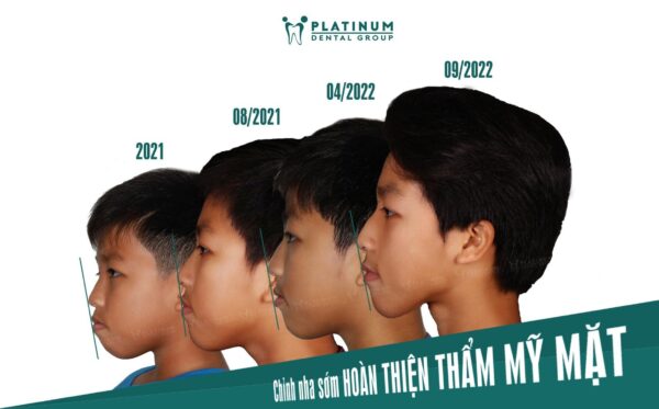 CHỈNH NHA SỚM - HOÀN THIỆN THẨM MỸ GƯƠNG MẶT 5 343078285 3490090244608212 8249100164595461074 n