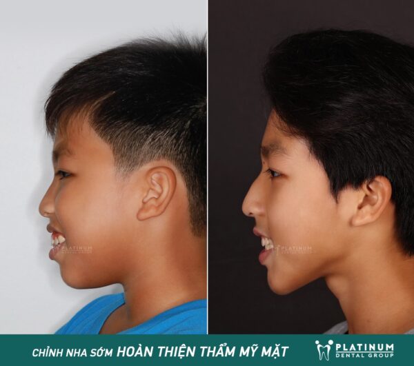 CHỈNH NHA SỚM - HOÀN THIỆN THẨM MỸ GƯƠNG MẶT 7 343091395 617352287076693 4464354568767415502 n