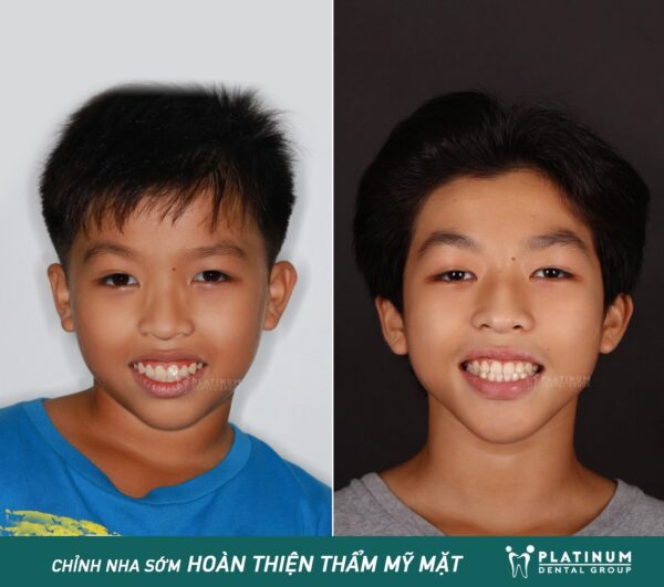 CHỈNH NHA SỚM - HOÀN THIỆN THẨM MỸ GƯƠNG MẶT 8 343143375 1834520970264882 5723170636808900231 n