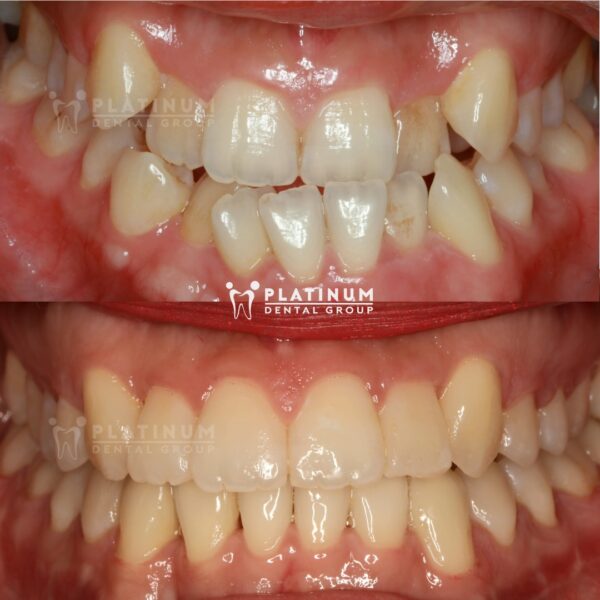 CÓ ĐƯỢC NỤ CƯỜI MƠ ƯỚC NHỜ CHỈNH NHA TẠI PLATINUM DENTAL 8 345666230 1610436762764375 5173489823280351802 n