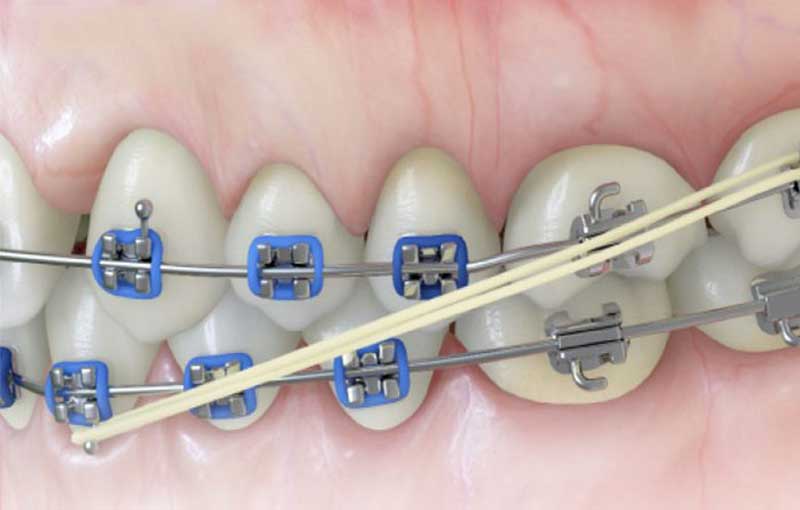 Dây thun niềng răng bị ố vàng nên xử lý thế nào?