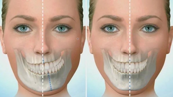 Niềng răng bị lệch nhân trung và cách khắc phục