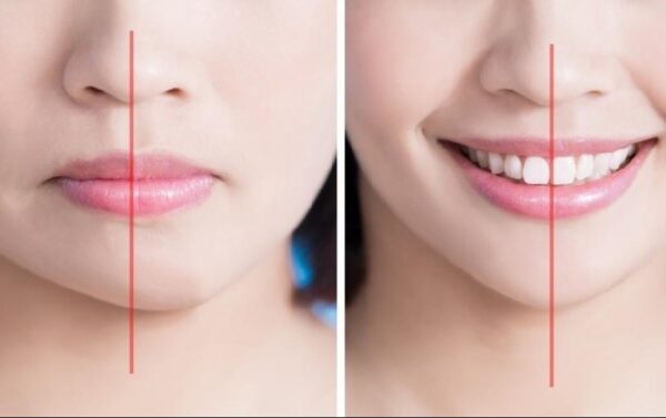 Biểu hiện của niềng răng bị lệch nhân trung
