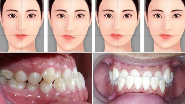 Các nguyên nhân khiến niềng răng lệch nhân trung