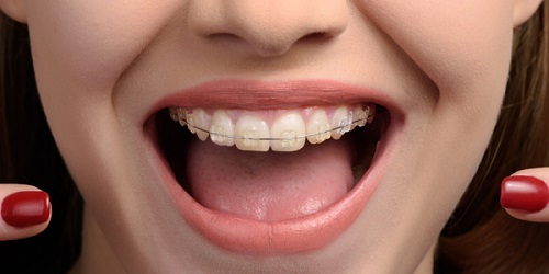 Nha khoa Platinum - địa chỉ niềng răng chỉnh nha uy tín và chất lượng