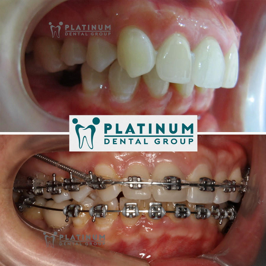 Niềng răng xong bị hô lại - Cách khắc phục là gì?