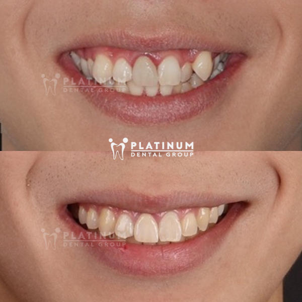 Răng sâu có niềng được không?