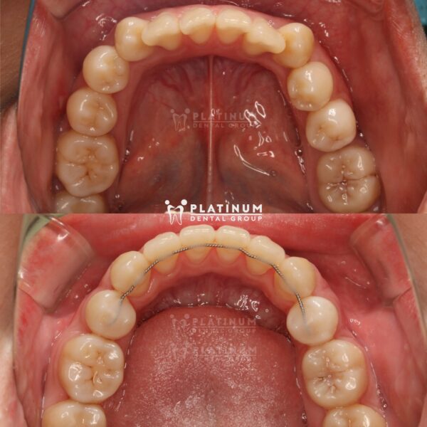 KẾT THÚC CASE NIỀNG RĂNG THÀNH CÔNG 5 351491420 160079037044475 2487478580974847798 n