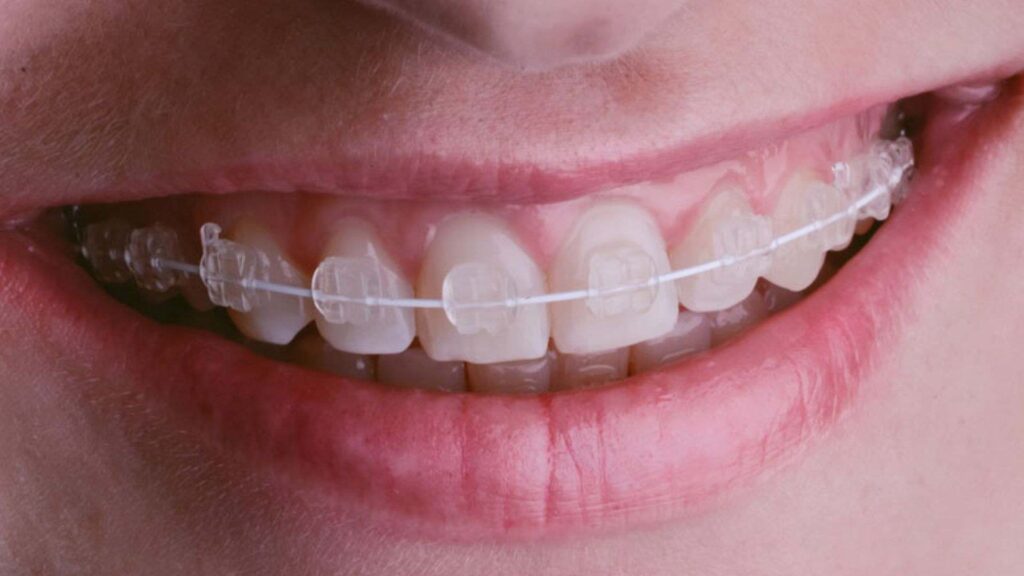 Những ai có thể niềng răng mắc cài pha lê