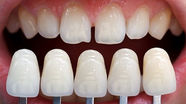 Are dental crown front teeth good?