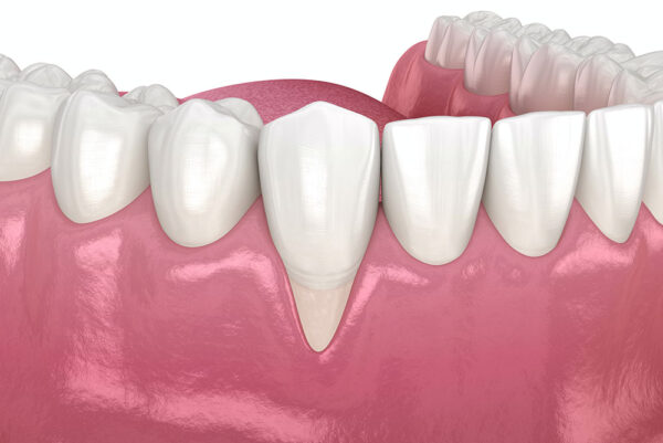 Increased sensitivity to hot and cold foods is the most typical sign of gum recession