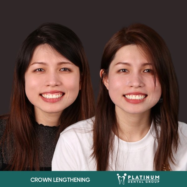 Crown Lengthening Treatment For A Natural, Radiant Look 2 Degrees of crown lengthening and how to identify them