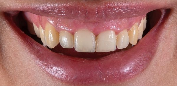 Crown Lengthening Treatment For A Natural, Radiant Look 1 A simple definition of crown lengthening