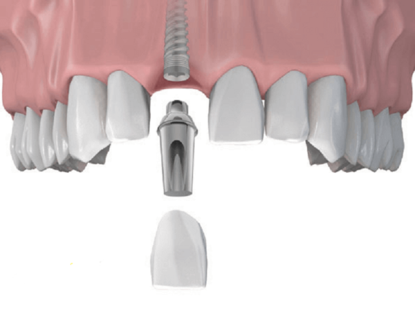 Features of Zirconium Implants. What are The Differences between dental implants titanium vs zirconium?