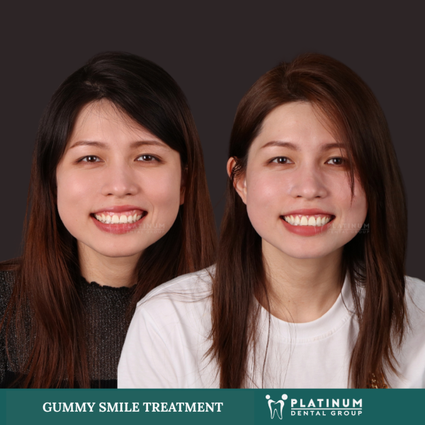 Gummy Smile Treatment 1 What is a gummy smile?